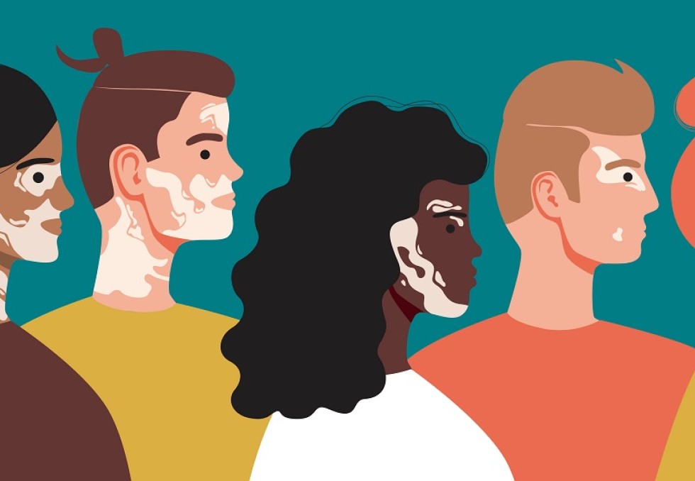vitiligo