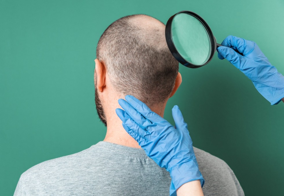 alopecie