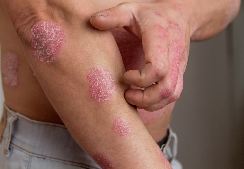 psoriasis