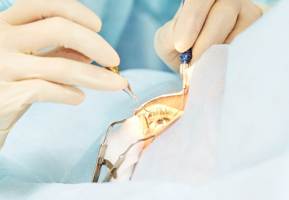 chirurgie de la cataracte