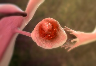 Cancer de l'ovaire