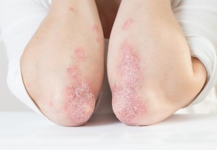 psoriasis