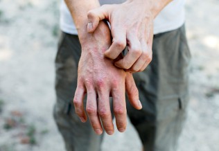 Dermatite atopique : une pathologie multifactorielle