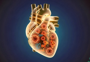 Myocardites et péricardites : identifier les formes graves