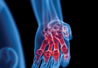 Polyarthrite rhumatoïde : le diagnostic précoce
