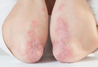 Psoriasis : stratégie diagnostique et thérapeutique