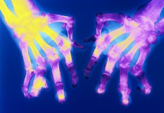 polyarthrite rhumatoïde