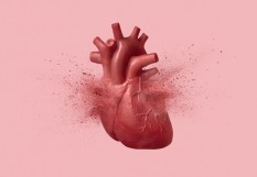 infarctus
