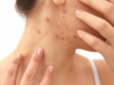 Le rôle du microbiote cutané fait l’objet d’études, en particulier dans l’acné et la dermatite atopique