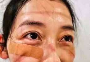 Plusieurs photos diffusées sur les réseaux sociaux chinois dévoilent les visages ravagés de médecins à force de porter des masques