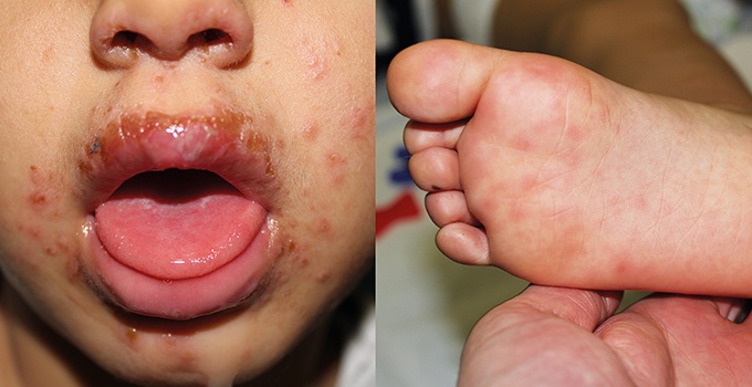 Santé – Le pied-main-bouche, l'autre virus qui circule à Genève